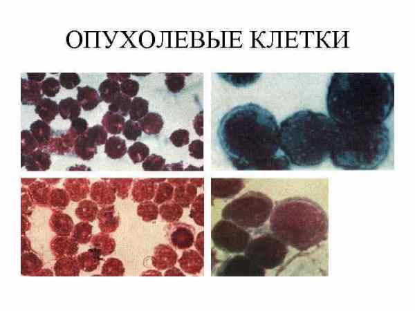 Опухолевые клетки в ликворе