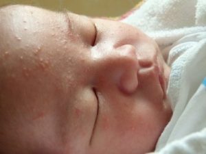 Андрогены надпочечников и акне новорожденных