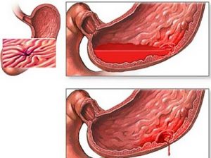 Желудочно - кишечные кровотечения