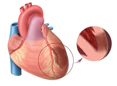 диагностика инфаркта миокарда