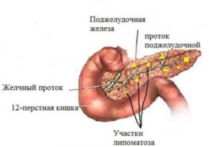 Липоматоз поджелудочной железы